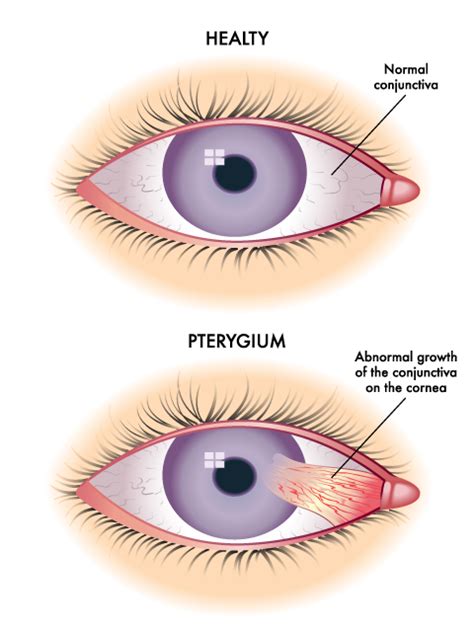 Pterygium | Associates Eye Care