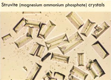 Struvite crystals | Medical Laboratories