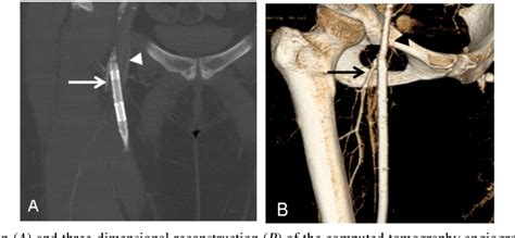 Figure 1 from Iatrogenic Profunda Femoris Stenosis after Superficial Femoral Artery Stenting ...