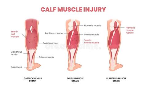 Calf Muscle Injury Infographic Stock Vector - Illustration of plantaris, tear: 276547971