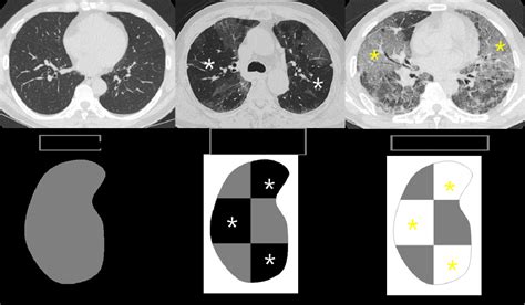 Pattern approach of mosaic attenuation: Radiological anatomy and strategy for differentiation ...