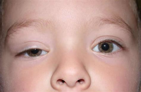Ptosis, droopy eyelid causes, droopy eyelid treatment and ptosis surgery