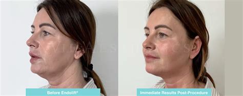 What Is The Best Non-Surgical Jowls Lift in 2024? - Vie Aesthetics