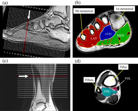 Foot Muscles Mri Anatomy - MRI of the Ankle: Detailed Anatomy - W-Radiology - fredrickson ...