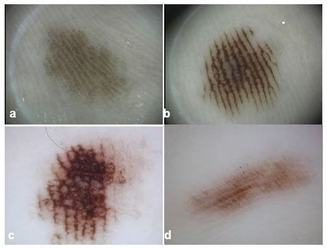 Acral Melanoma: Clinical, Biologic and Molecular Genetic Characteristics | IntechOpen