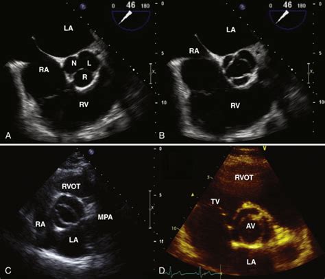 Valves: Echocardiography | Radiology Key