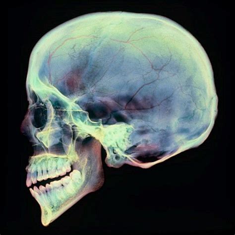 A colored X-ray of a sagittal section through a human skull from a ...