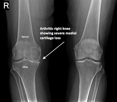 Knee Xray - Century City Los Angeles, CA: Commons Clinic