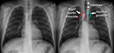 Student Corner: How To Read A Chest X-Ray EM REMS, 53% OFF