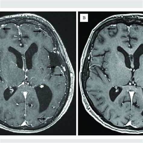 MRI. (A) December 2018, post-contrast enhancement in the leptomeninges ...