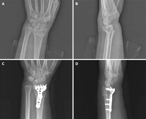 Non displaced distal radius fracture - knowledgekool