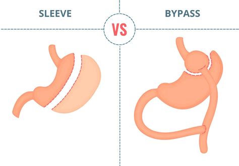 Qual a diferença entre cirurgia bariátrica Sleeve e Bypass? - IBEMC Dr. Nestor