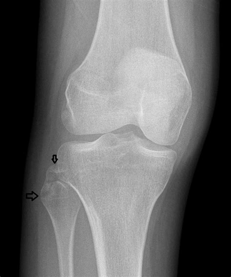 Arcuate Ligament Knee