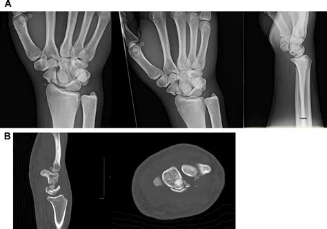 Fractures of the Carpal Bones - Clinics in Plastic Surgery