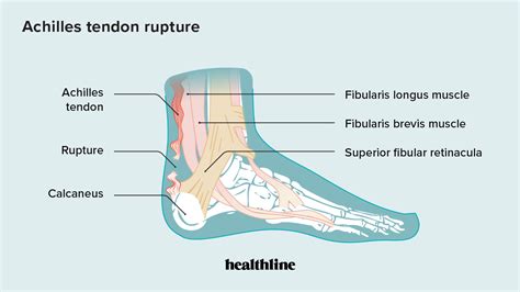 Torn Achilles Tendon | atelier-yuwa.ciao.jp