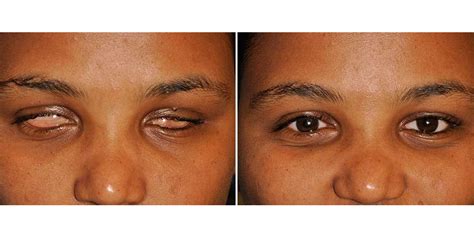 Ocular Prosthetics – Advanced Prosthetics and Orthotics