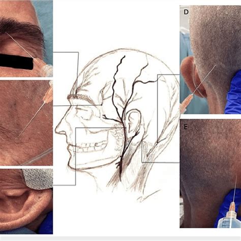 Regional scalp block for awake craniotomy: (a) supraorbital nerve, (b ...