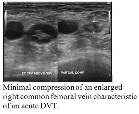 minimal compression, right common femoral vein, image characteristic of ...