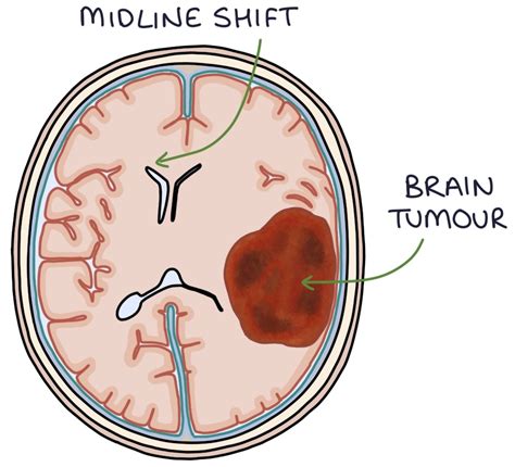 Brain Tumours – Zero To Finals