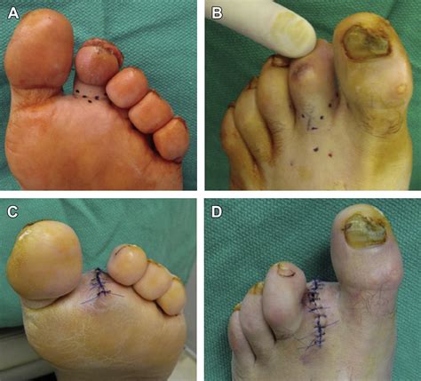 2015 Icd 10 Code For Post Op Amputation Foot