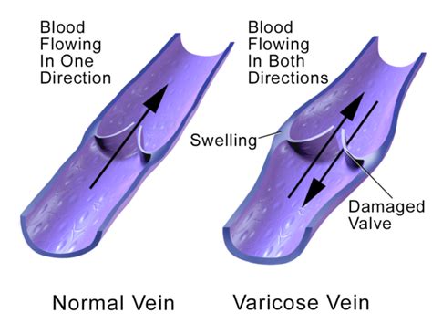 Five Things You Should Know About Venous Reflux Disease | Skin & Vein Center