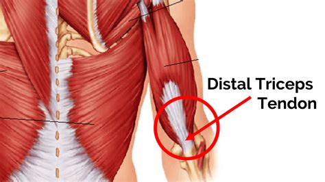 triceps tendon - Barbell Rehab