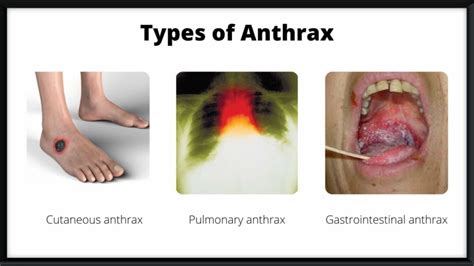 What Are The Causes, Symptoms, And Treatment Of Anthrax?