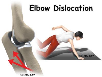 With a simple elbow dislocation (stable, no other injuries): after reduction, the elbow will be ...