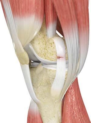 Ligament Injuries & Tears, Repair Auburn Hills, MI | ACL, MCL & PCL Tear Oakland County ...