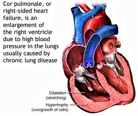 Cor pulmonale causes, symptoms, diagnosis, prognosis and treatment