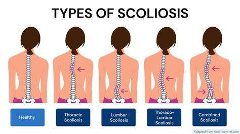 Is Scoliosis Genetic? - Xcode Life