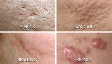 Types Of Acne and Scar - Avalon Medispa