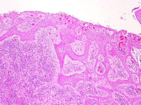 Histological analysis of 41 dentigerous cysts in a paediatric population - Huang - 2019 ...