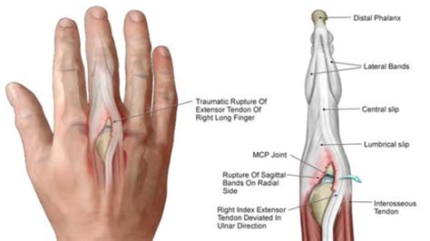 시상대 파열 ( Sagittal Band Rupture ) : 네이버 블로그