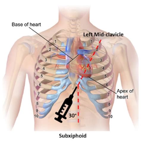 How to perform a pericardial effusion puncture