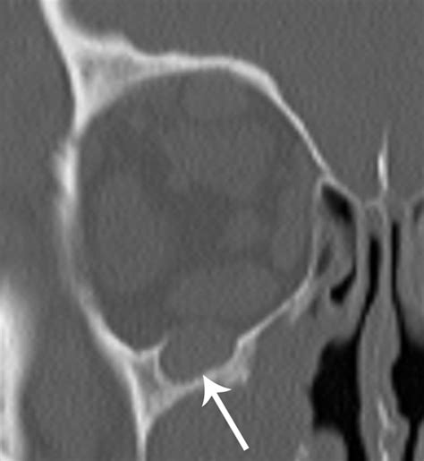 Immunoglobulin G4–Related Disease of the Orbit: Imaging Features in 27 Patients | American ...