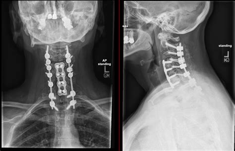 Cervical posterior fusion - Joshua Li, MD, PhD