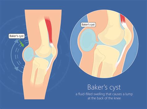 Popliteal or Baker’s Cyst Overview | Town Center Orthopaedics