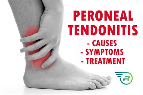 Can You Treat Peroneal Tendonitis with Compression Socks? - Run Forever ...