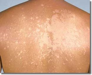 Fungal Infection at best price in Noida | ID: 9843324797