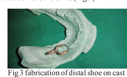 Willet’s distal shoe appliance for early loss of second deciduous molar: A case report with 2 ...