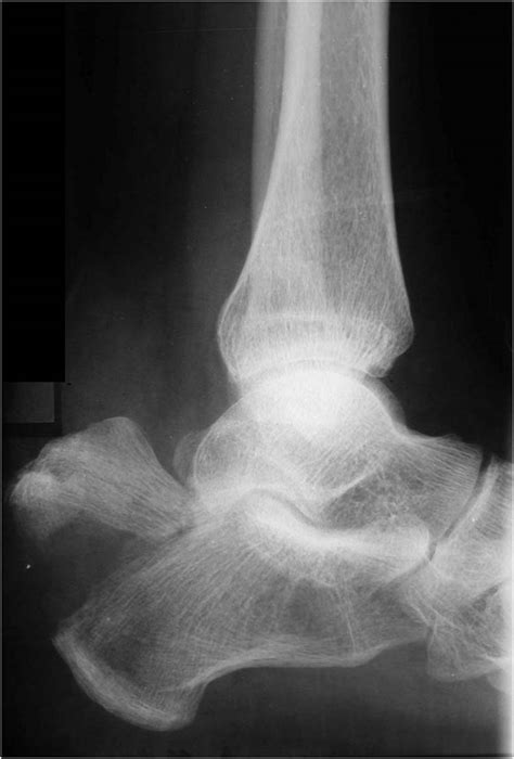 CALCANEAL AVULSION FRACTURE | Buyxraysonline