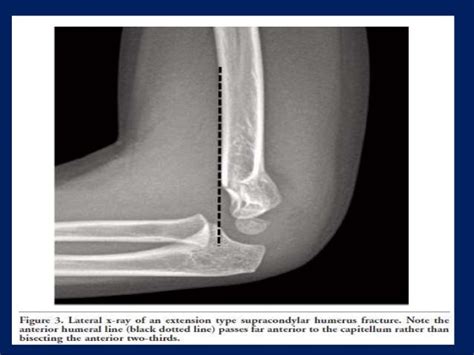 Cubitus varus deformity