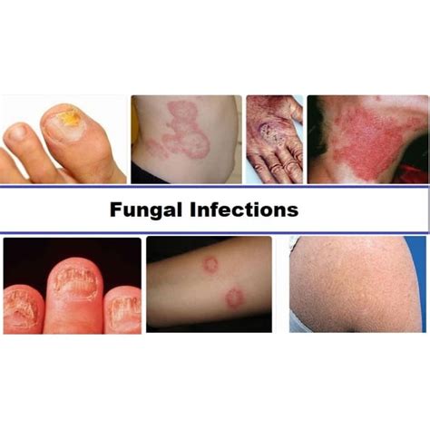 PREVENTING FUNGAL INFECTIONS | Education