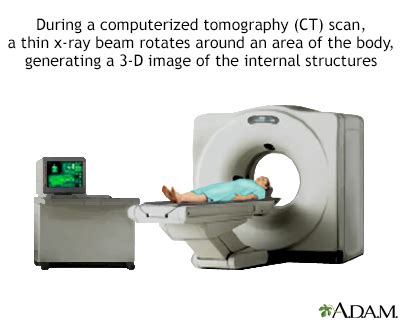 Abdominal CT scan Information | Mount Sinai - New York