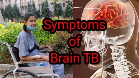 Symptoms of Brain TB. Tuberculosis meningitis ke lakshan.Colours of life - YouTube