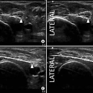 (PDF) Randomized comparison of popliteal-sciatic perineural catheter tip migration and ...