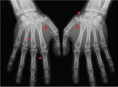 Vascular Calcifications in Calcific Uremic Arteriolopathy | ClinMed International Library ...