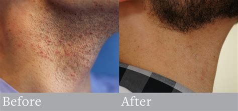 Electrolysis for men and Athletes | 100% Permanent Hair Removal