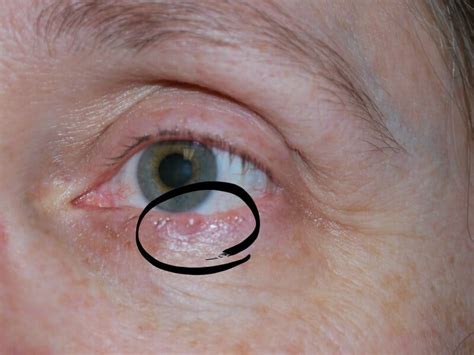 Skin Cancer On Lower Eyelid